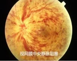 眼底病，常見的眼底病