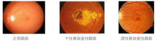 眼底病，常見的眼底病