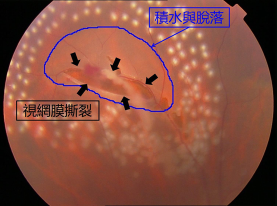 眼底病，常見的眼底病
