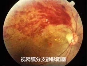 眼底病，常見的眼底病