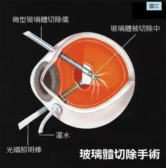 眼底病,眼底玻切手術