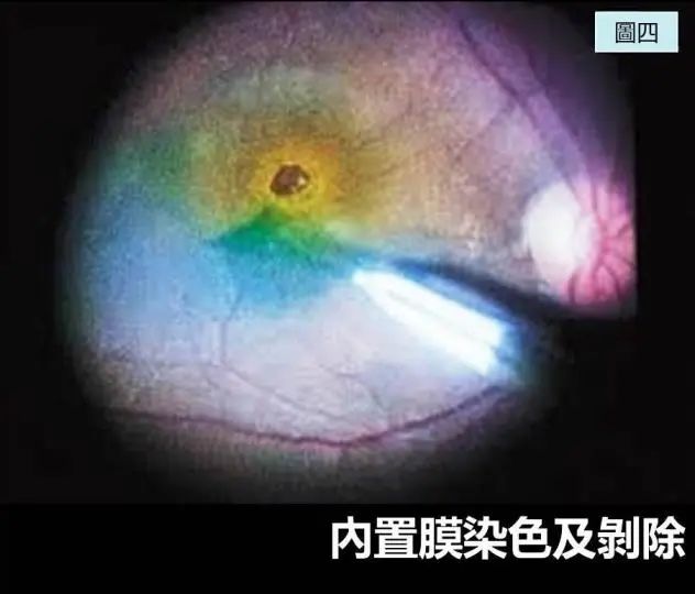 眼底病,眼底玻切手術