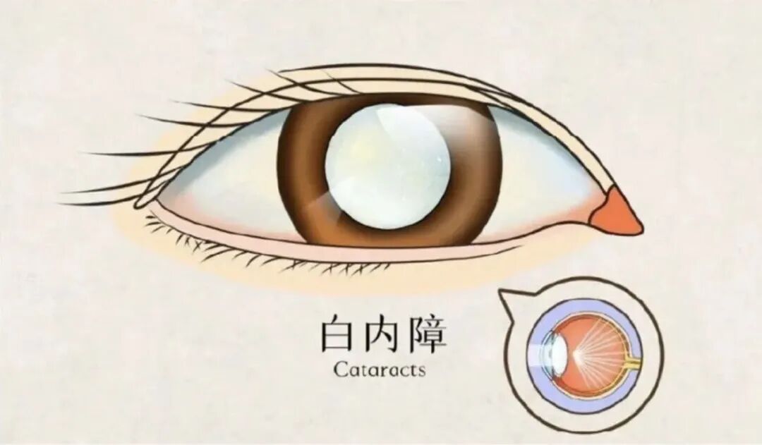 白内障,白內障術後如何護理 白内障,白內障術後如何護理