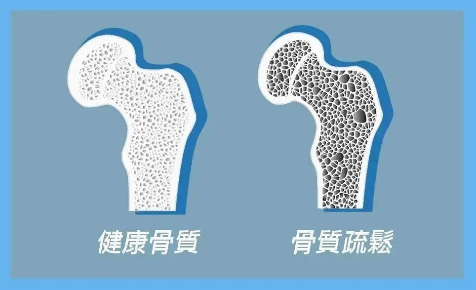 骨量流失,骨骼健康,骨質疏鬆,骨質疏鬆怎麼辦 骨量流失,骨骼健康,骨質疏鬆,骨質疏鬆怎麼辦