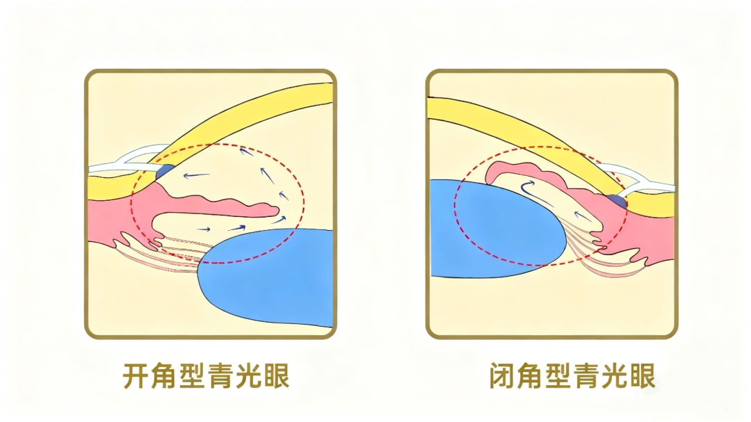 幹眼症,青光眼,眼中風 幹眼症,青光眼,眼中風