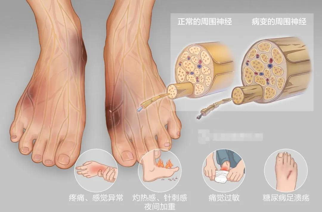 糖尿病,糖尿病篩查 糖尿病,糖尿病篩查