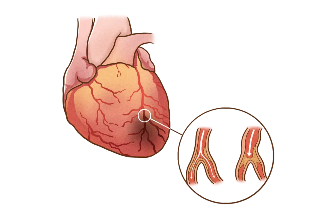 糖尿病,糖尿病篩查 糖尿病,糖尿病篩查