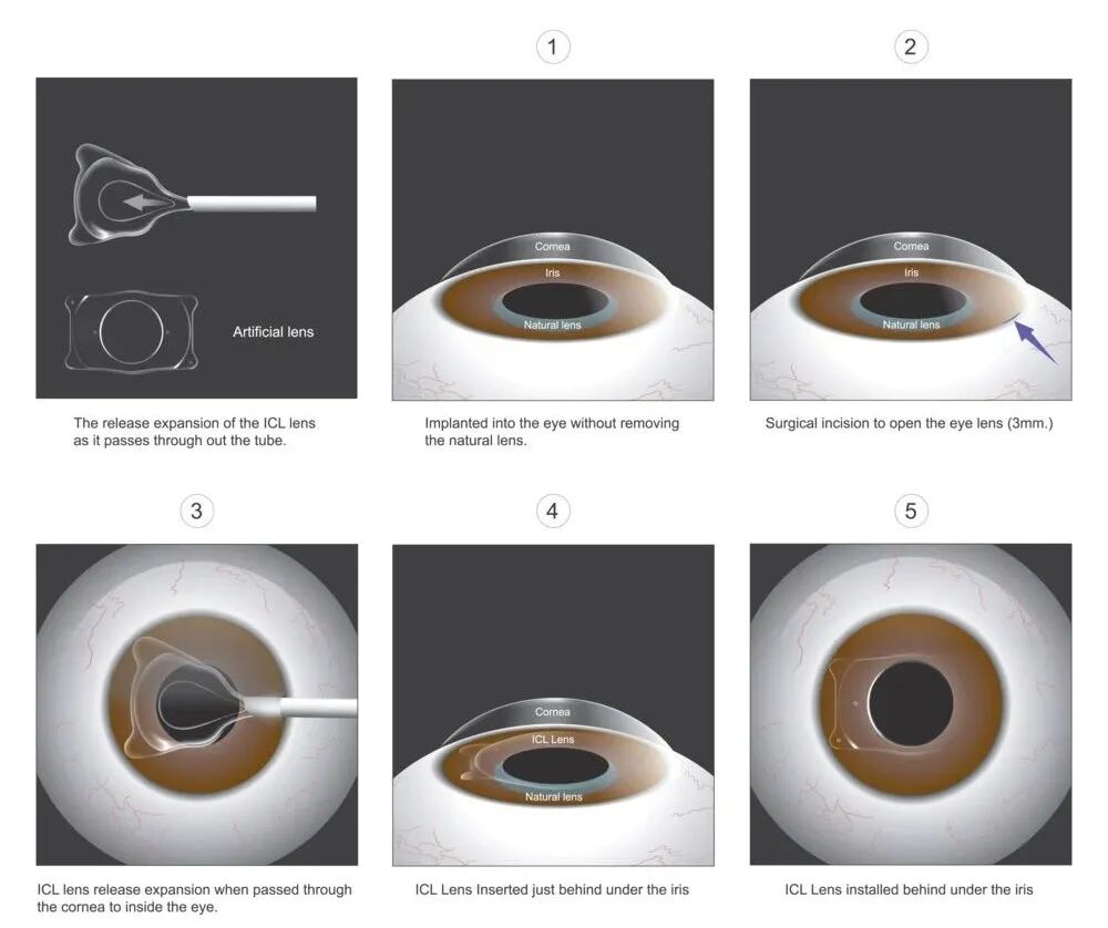 近視手術,激光近視手術,ICL晶體植入 近視手術,激光近視手術,ICL晶體植入