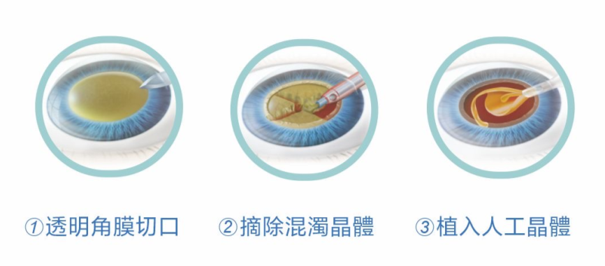 白內障手術,白內障人工晶體怎麼選,深圳希華愛康健醫院 白內障手術,白內障人工晶體怎麼選,深圳希華愛康健醫院